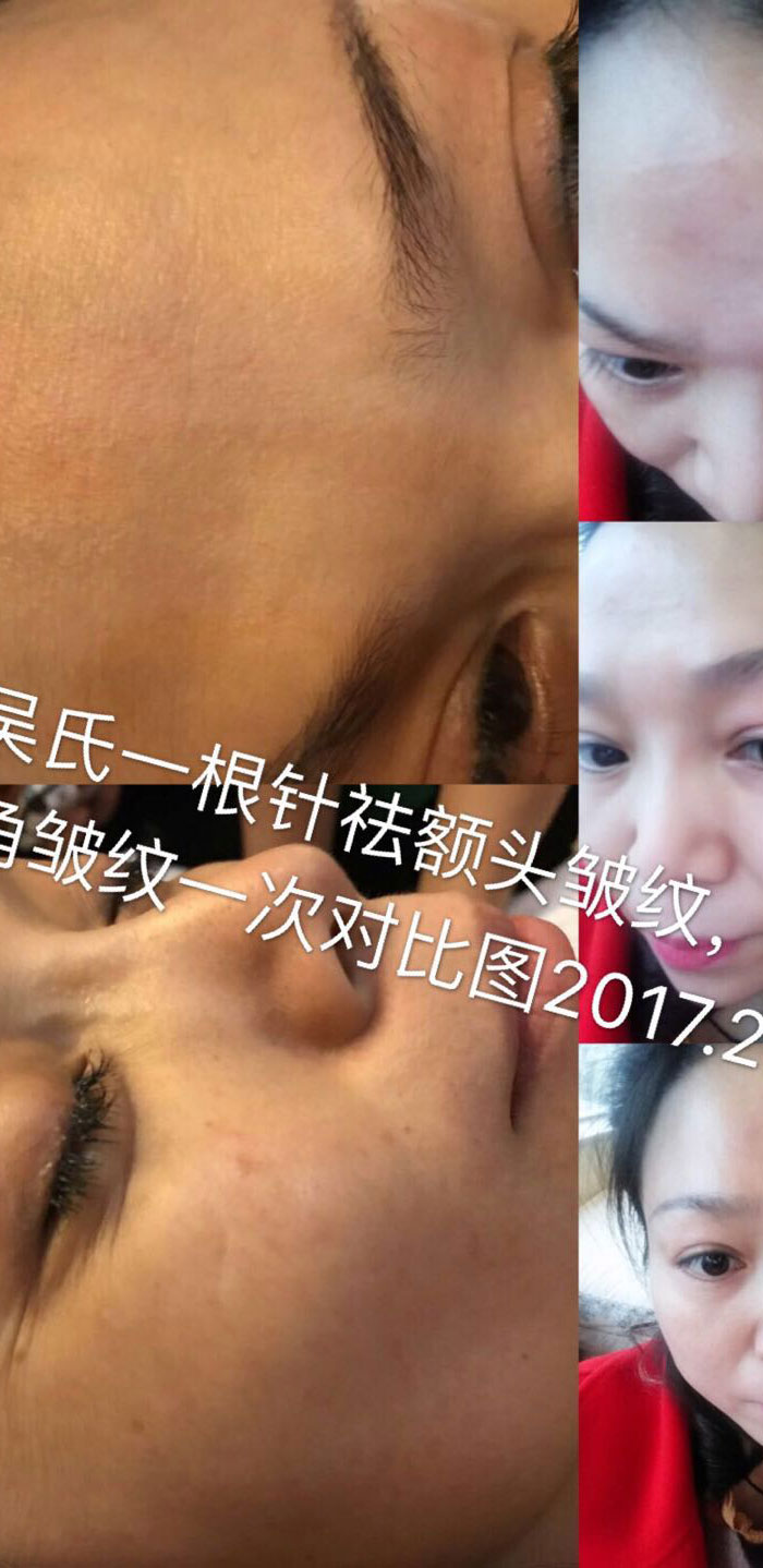 吴氏手绣美雕微整形手绣美雕效果对比图